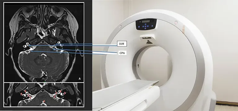 A Complete Guide To MRI Vertigo Protocol Uses, Preparation, Procedure and Benefits